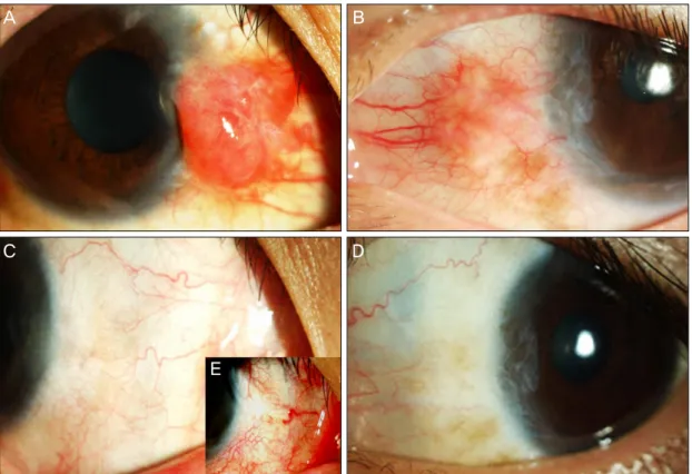 Fig. 1. (A) Slit lamp photograph of the patient’s right eye on initial presentation. Note the size, salmon color, and ele- ele-vated appearance of the hypervascular lesion