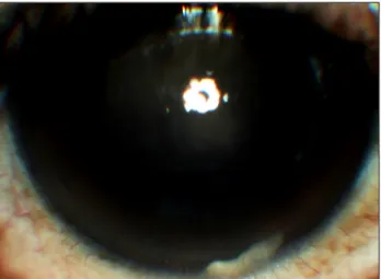Fig. 2. Slit lamp examination two months after removal of the lens  fragment shows improved corneal edema.