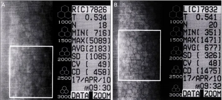 Fig. 3. Specular pachymetry two months after removal of the lens fragment shows a significant decrease in endothelial cell count (458  cells/mm 2 ) and loss of hexagonality in the right eye