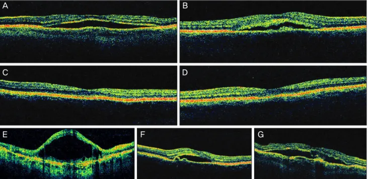 Fig. 3. Factors for investigation in optical coherence tomography findings. From (A) to (G) represents serous retinal detachment, intact outer  photoreceptor layer with bulging on the retinal pigment cell (RPE) layer, intact and disrupted outer segment, in