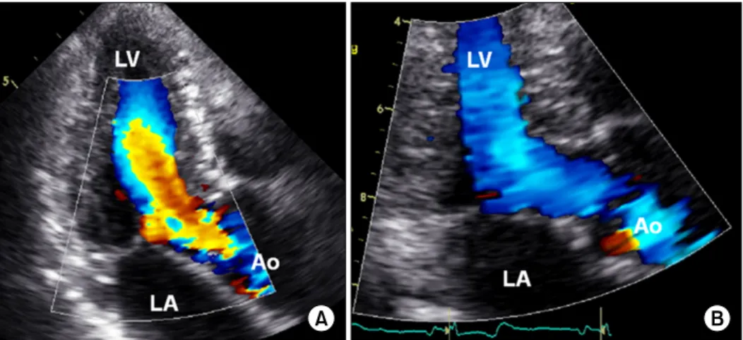 Fig. 3. (A) Color Doppler image taken at the time of anemia (hemoglobin, 8.3 g/dL). Note the aliasing of color Doppler from the mid-level  of left ventricular (LV) to LV outflow tract LVOT, suggesting flow acceleration and dynamic obstruction