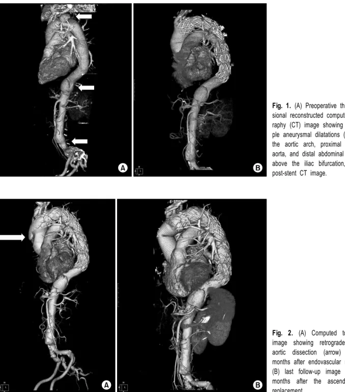 Fig. 1. (A) Preoperative three-dimen- three-dimen-sional reconstructed computed  tomog-raphy (CT) image showing the  multi-ple aneurysmal dilatations (arrows) in  the aortic arch, proximal abdominal  aorta, and distal abdominal aorta just  above the iliac 