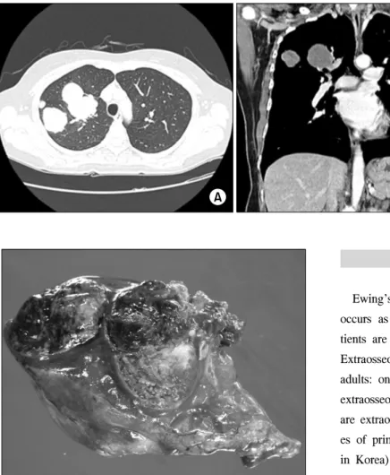 Fig. 1. Chest computed tomography  of the patient showing masses in  the right upper lung lobe