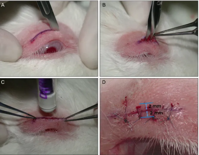 Fig. 1. Surgical technique. (A) A eyelid incision of approximately 15 mm was made. (B) The incision was blotted dry using cot- cot-ton swabs