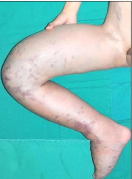 Fig. 1. Photo of arteriovenous malformation of right lower limb.