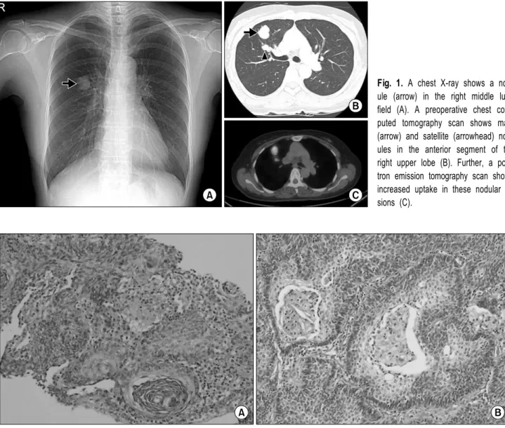 Fig. 1. A chest X-ray shows a nod- nod-ule (arrow) in the right middle lung  field (A)