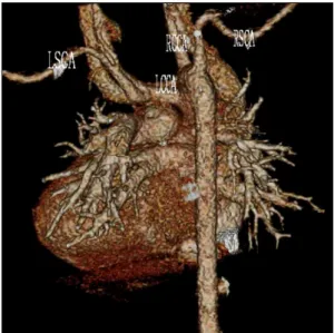 Fig. 2. Postoperative three-dimensional 64-row multidetector com- com-puted tomography revealed LSCA arising from the LCCA without  stenosis