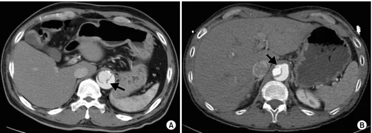 Fig. 1. (A, B) The intimal tear (arrow) connecting the true and the false lumen in the dissected descending aorta.