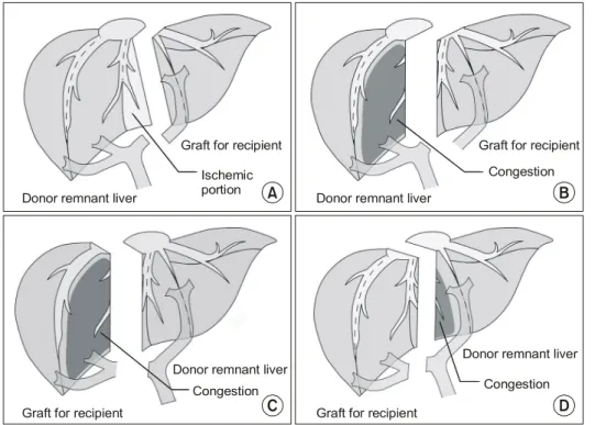 Fig.  2.  Various  types  of  donor  he- he-patectomy  (Ref.  7,  Fig.  2). 