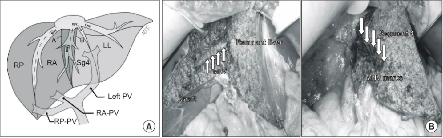 Fig.  3.  Modified  extended  right  hepatectomy  (MERH)(Ref.  3,  Fig.  3).  (A)  Line  (A)  represents  the  transection  line  for  MERH,  which  is  the  same  as  that  use  in  right  hepatectomy,  whereas  line  (B)  is  used  for  extended  right  