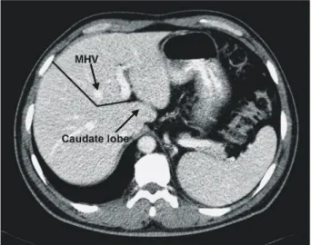 Fig.  7.  Hanging  maneuver  in  the  extended  left  hepatectomy  (Ref.  7,  Fig.  7)