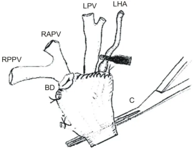 Fig.  8.  High  hilar  dissection  for  the  recipient's  hepatectomy  (Ref. 
