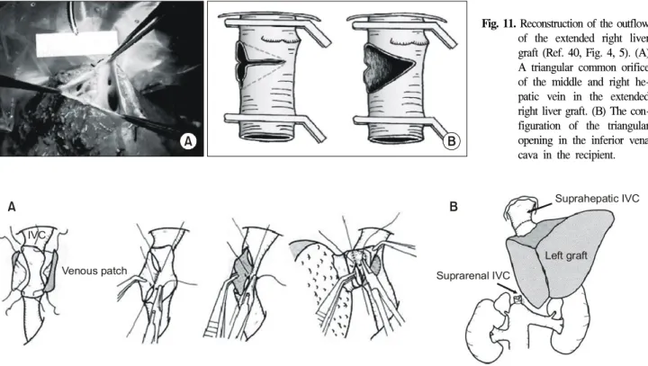 Fig.  11.  Reconstruction  of  the  outflow  of  the  extended  right  liver  graft  (Ref