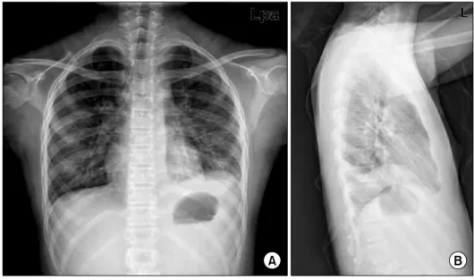Fig. 2. Serial chest computed tomography. (A) Initial scan: bilateral pleural effusions and multiple small nodules throughout lungs