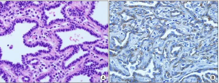 Fig. 3. (A) Cuboidal to columnar cells nondestructively follow alveolar contours (H&amp;E, ×400)