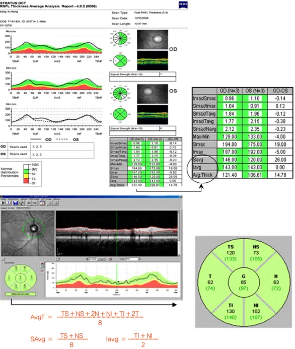 Fig. 1. Example Stratus time domain-optical coherence tomography (OCT) and Spectralis spectral-domain-OCT  scan image and retinal nerve fiber layer thickness map display in the eye of a healthy participant