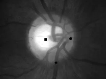 Table 1. Mean gray scale and inter-observer reproducibility of the nasal rim, brightest cupping center and largest inferior retinal vein