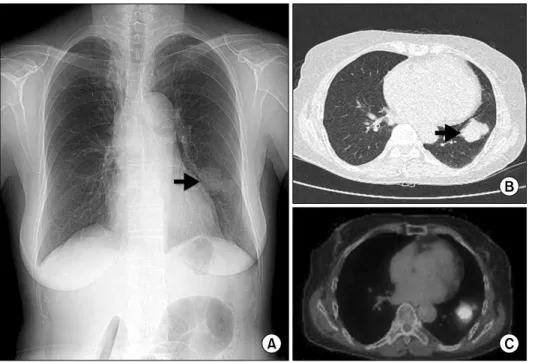 Fig. 1. (A) Chest X-ray shows a  nodule (arrow) in the left lower lung  field. (B) Chest computed  tomog-raphy scan shows 4×3 cm lobulated  nodule in the basal segment of the  left lower lobe