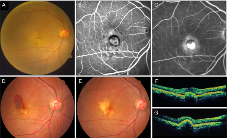 Fig. 3. (A) A 59-year old woman with a visual acuity (VA) score of 0.02 had classic choroidal neovascularization revealed in early (B) and late  phase (C) fluorescein angiography