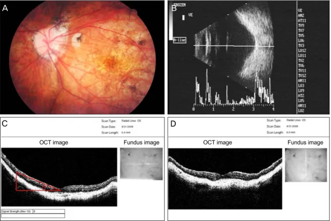 Fig. 1. Images showing posterior staphyloma. A 51-year-old woman with 20 / 40 visual acuity and a -11 diopter spherical  equivalent