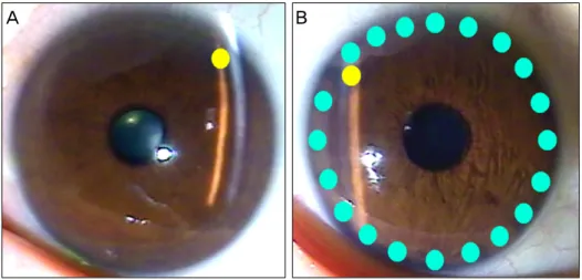 Fig. 1. Conventional laser periph- periph-eral iridotomy (LPI) and the LPI  combined with iridoplasty technique.