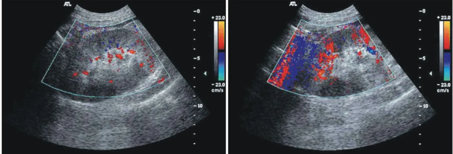 Fig.  1.  Renal  Doppler  ultrasonography  on  day  15  shows  increased  renal  parenchymal  echogenecity  and  relatively  normal  perfusion