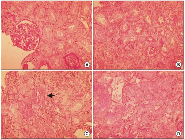 Fig.  3.  Pathologic  findings  of  graft  biopsy.  (A)  There  is  no  cellular  proliferation  or  inflammatory  cell  infiltration  in  glomerulus