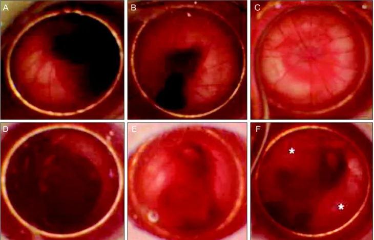 Fig. 1. Fundus photographs showing time-dependent fundus changes followed by laser induced retinal trauma in the experimental group (A-C)  and control group (D-F)
