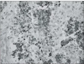 Fig.  2.  Tumor  cells  show  paranuclear  dots-like  positivity  of  CK20  (LSAB,  ×400).