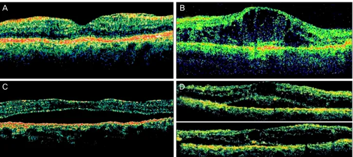 Fig. 1. The classification of diabetic macular edema according to optical coherence tomography features