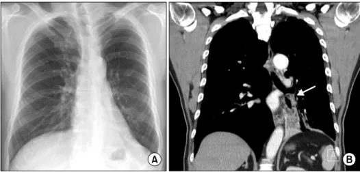 Fig. 2. Preoperative flexible bronchoscopy shows the endobron- endobron-chial mass.