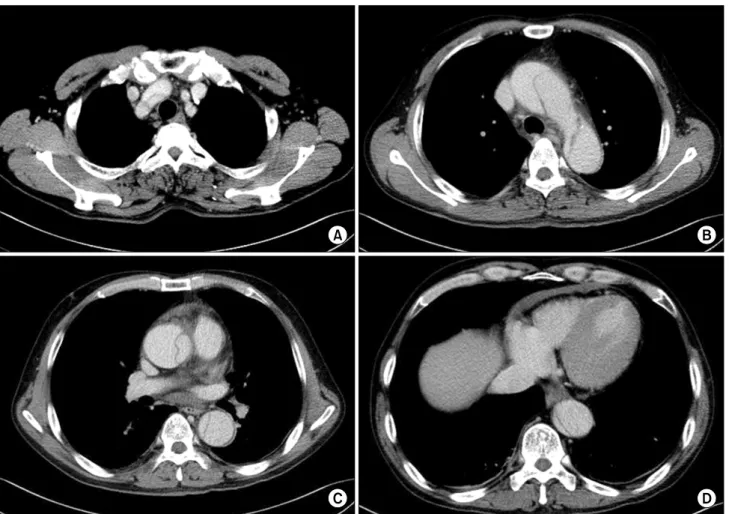Fig. 1. Preoperative computed tomography revealed aortic dissection involving (A) the innominate artery, (B) aortic arch, and (C) ascending  and descending thoracic aorta