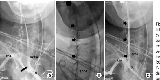 Fig. 3. (A) A patent IA and RSA  but obstructed RCCA were revealed  by angiography. An intimal tear  oc-curred at the IA bifurcation site  (arr-ow)