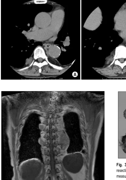 Fig. 2. Magnetic resonance imaging showed that the signal in- in-tensity of the tumors was mainly isointense with that of the bone  marrow and partially isointense with that of the adipose tissue.