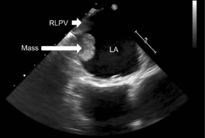 Fig. 2. Pathologic finding of cardiac hemangioma. (A) Myocardium shows ill-defined aggregates of closely packed, thin-walled capillaries fil- fil-led with blood cells (H&amp;E, ×200)