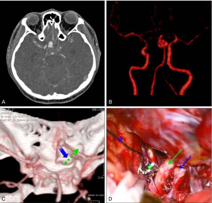 Fig 1. Preoperative brain three-dimensional (3D) computed tomographic angiography images