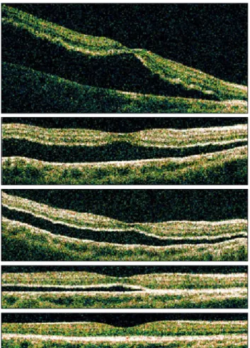 Fig. 1. Serial changes of typical time-domain optical coherence to- to-mography (horizontal scans) in a case with persistent submacular  fluid after successful scleral buckle surgery for rhegmatogenous  reti-nal detachment
