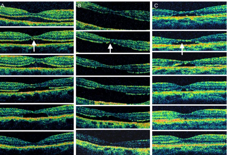 Fig. 2. Optical coherence tomography findings (horizontal scans) of cases 1-3 (A-C). Arrows indicate the disrupted photoreceptor inner and  outer segment line
