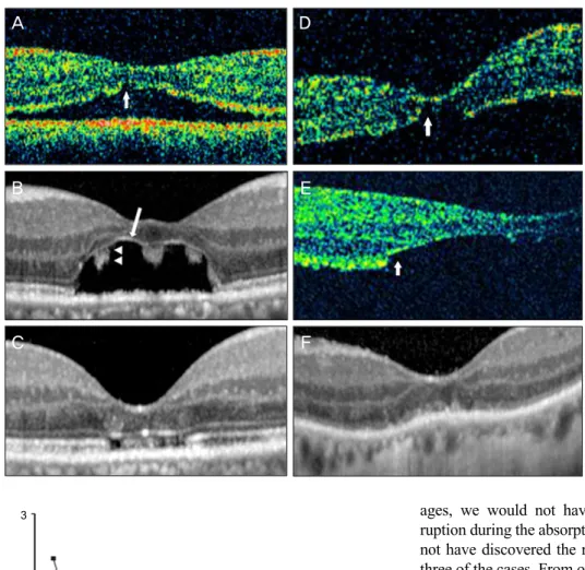 Fig. 3. Optical coherence tomog- tomog-raphy (OCT) findings of fovea in  cases 1 (A-C) and 2 (D-F)