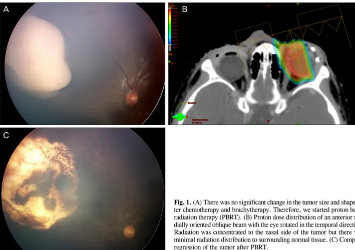 Fig. 1. (A) There was no significant change in the tumor size and shape af- af-ter chemotherapy and brachytherapy