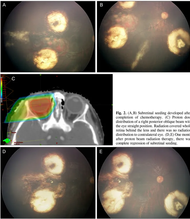 Fig. 2. (A,B) Subretinal seeding developed after  completion of chemotherapy. (C) Proton dose  distribution of a right posterior oblique beam with the eye straight position