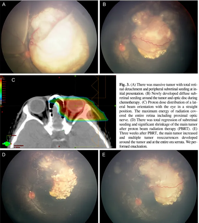 Fig. 3. (A) There was massive tumor with total reti- reti-nal detachment and peripheral subretireti-nal seeding at  in-itial presentation