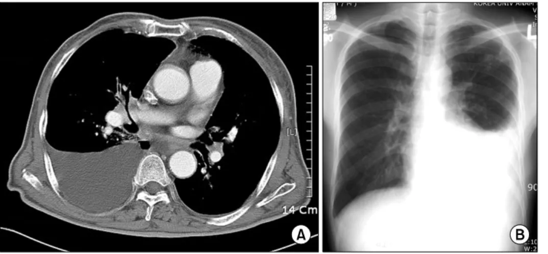 Fig. 1. Radiological findings upon  preprocedural evaluation. (A) Chest  computed tomography of a 78-year-  old male patient