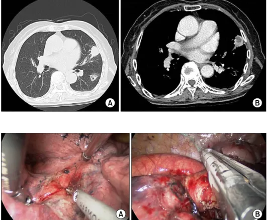 Fig. 1. (A) Computed tomography  revealed a mass measuring  approx-imately 3.3×2.2 cm in the lingula  and a nodule measuring 2.2×1.6 cm  with speculation in the superior  seg-ment of left lower lobe