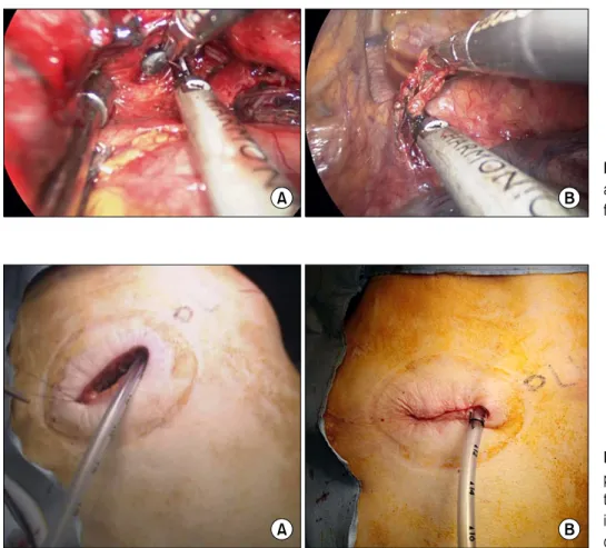 Fig. 4. (A) Subcarinal and (B) para-  aortic lymph nodes were dissected  for complete resection.