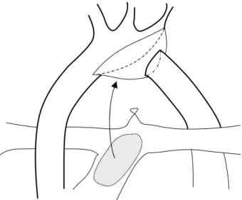 Fig. 2. (A) Preoperative computed  tomography (CT) image shows a  lon-ger distance between the ascending  and the descending aorta than that  in the case of the usual type A  in-terrupted aortic arch