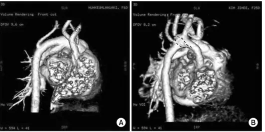 Fig. 3. (A) Preoperative computed  tomography (CT) image. (B)  Postope-rative CT image of type B interrupted aortic arch