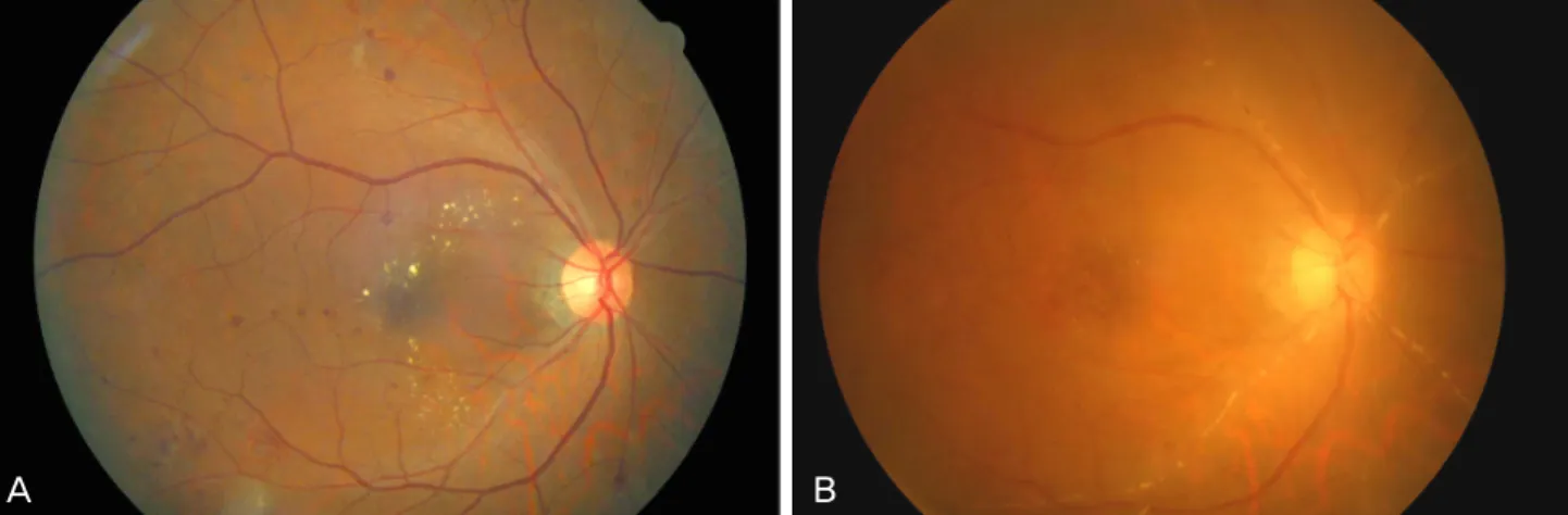 Fig. 1. Fundus photography of the right eye. (A) Before intravitreal injection of triamcinolone acetonide (IVTA), only mild diabetic changes  can be seen