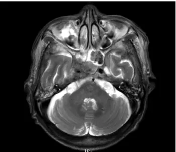 Fig. 5. Schematic drawing demonstrating the anatomy of the poste- poste-rior portion of the cavernous sinus on the right side
