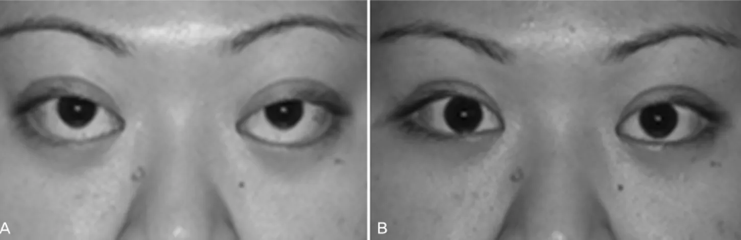 Fig. 3. Thyroid-associated ophthalmopathy (TAO). The patient complained of a proptotic and surprised look, although her hyperthyroidism  was well controlled